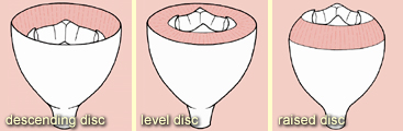 Variation in the disc: descending disc, level disc, raised disc
