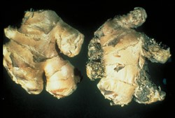 Photo 3. Root-knot nematode, Meloidogyne sp., on ginger. Note that the damage is on the young buds, and that the decay has probably occurred in storage. A healthy rhizome is on the left.